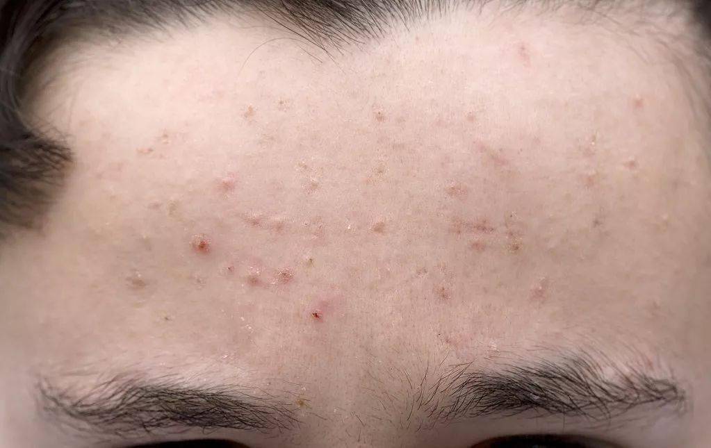 吃什么可以减少皮脂腺油脂分泌过多 a8147e6070d54c2bbab537abee6d7135.jpeg