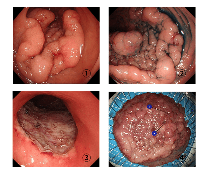 肛门绒毛状腺瘤图片图片
