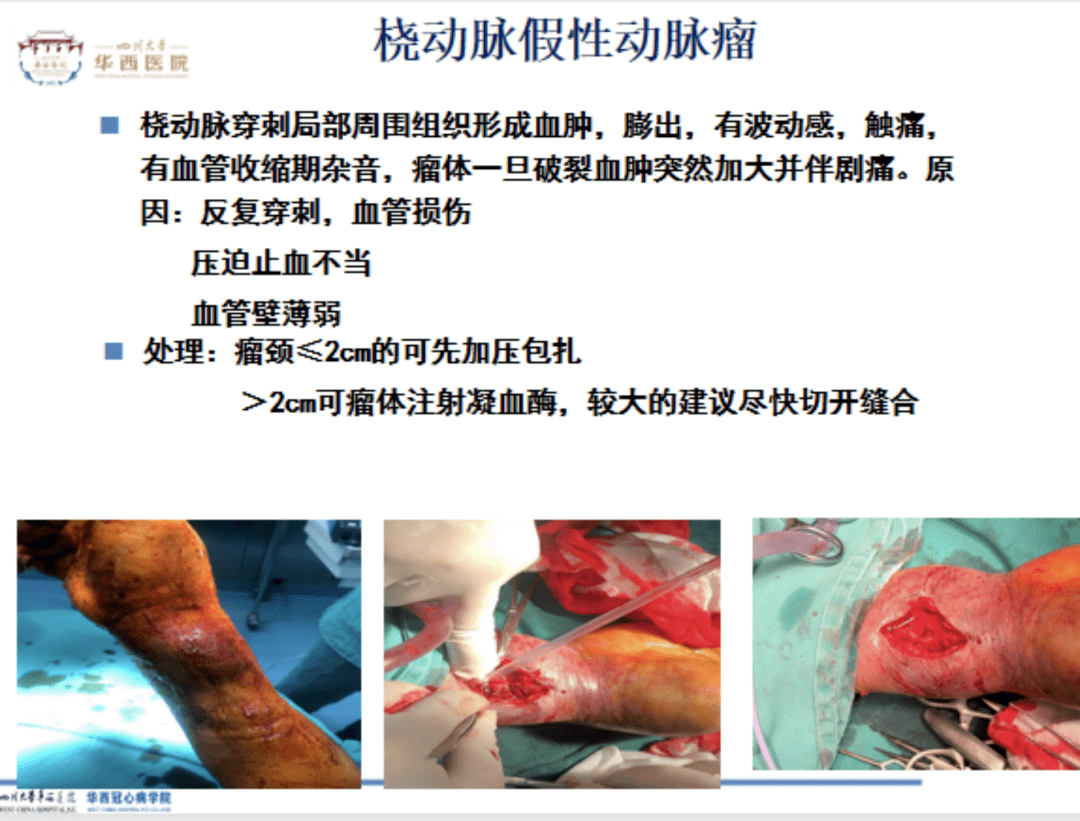 桡动脉入路并发症还包括前臂动脉破裂,夹层,造影剂外渗,前臂血肿,骨