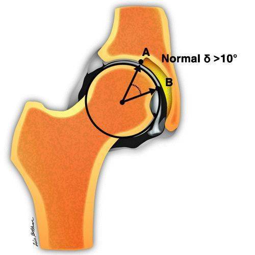 图 5b-髋臼指数角(tonnis角度)的测量.