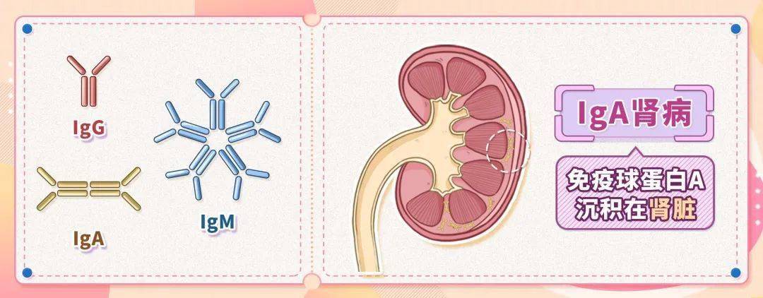 科普|院士讲科普 | IgA肾病一定会导致尿毒症吗?