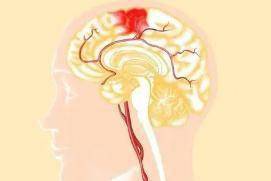 内皮|女子年仅26岁，为何两次遭遇脑出血？脑出血来临之前，哪些信号要警惕？