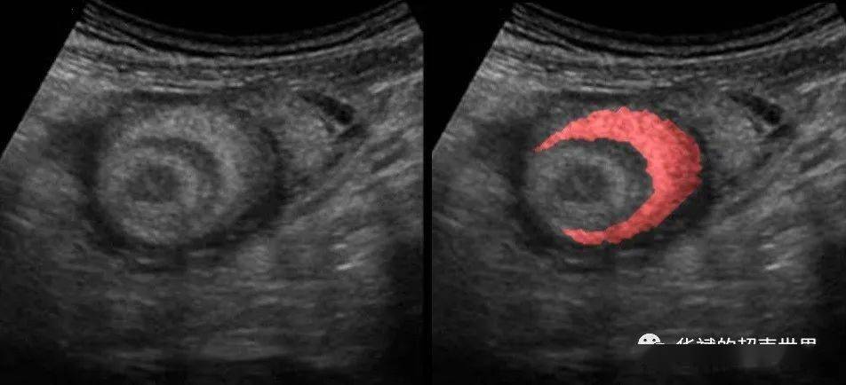 超声征象新月征(crescent sign)