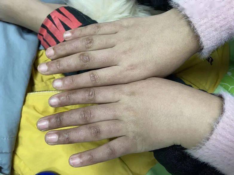 幼年皮肌炎治疗前后皮疹对比得了幼年皮肌炎怎么办?