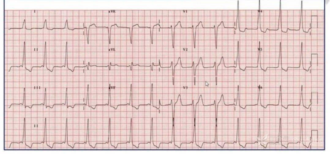 c型预激综合征心电图图片