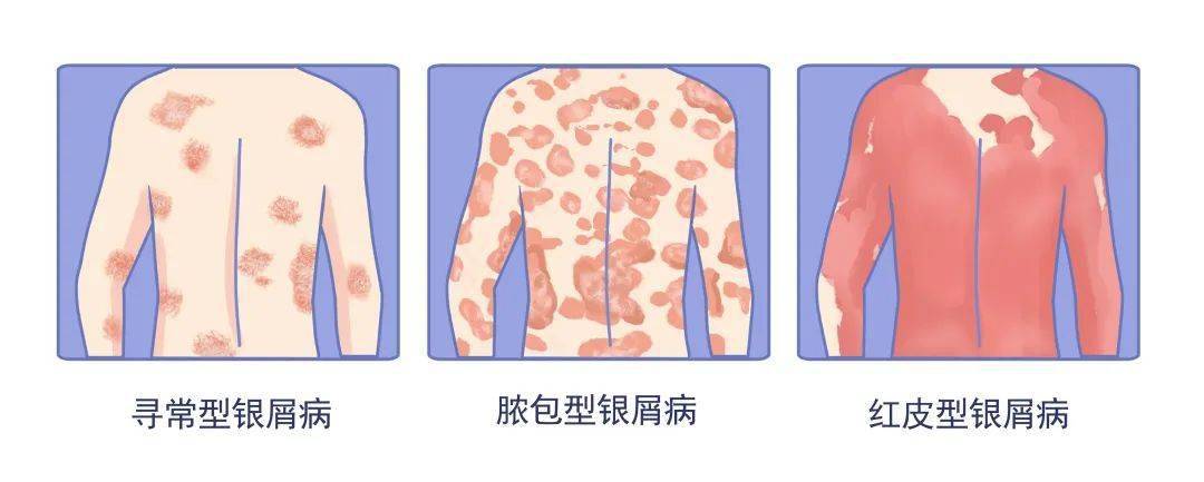 江西治疗牛皮癣