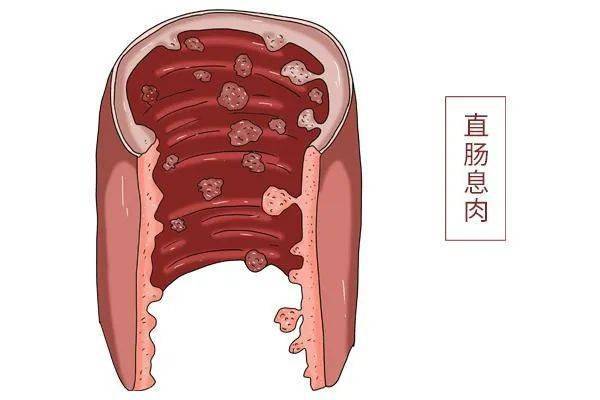 便血的問題可大可小