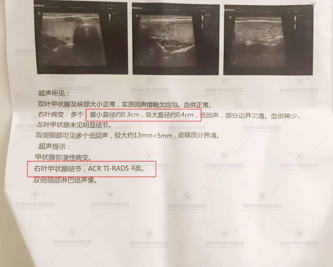 体检发现3毫米结节医生建议观察结果半年竟然成癌