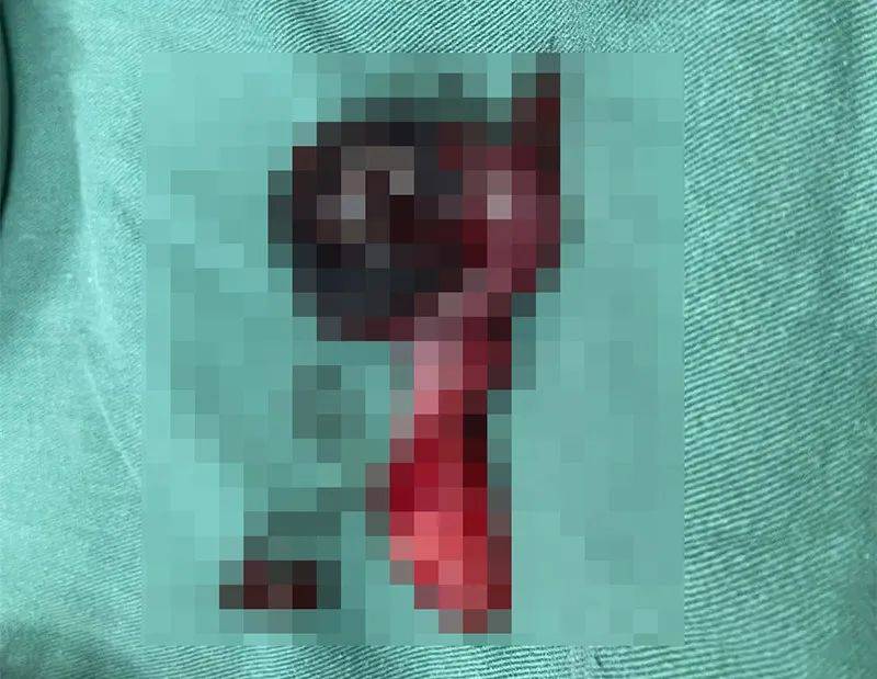 阴囊|男孩睡觉时突然「蛋疼」，到医院一看，已经不得不切除