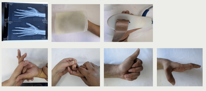 手部外伤术后康复方案及技巧 一次性讲清楚 关节