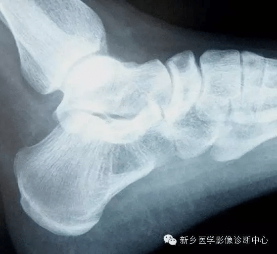 这6张跟骨图像你能分得清吗
