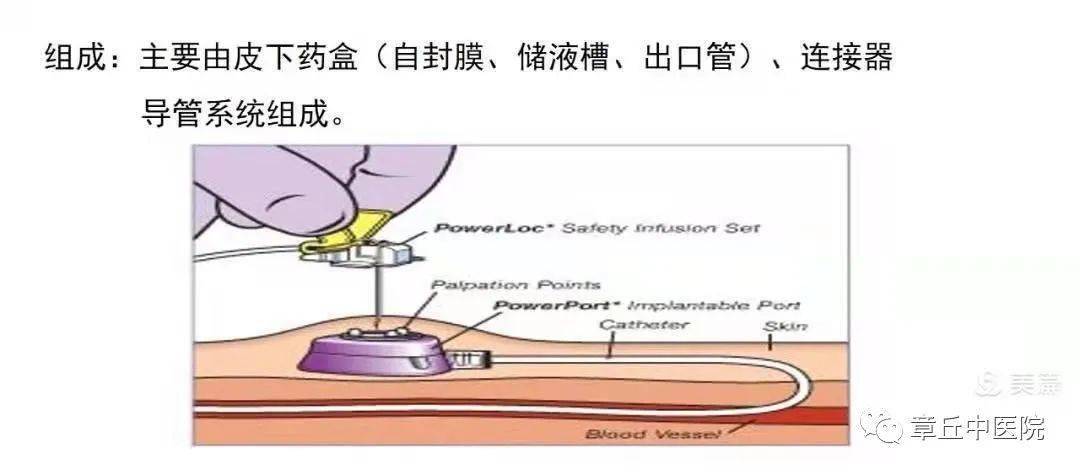 输液港的组成图片图片