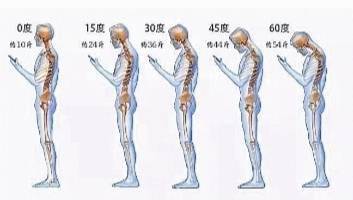 胸椎|长时间低头 颈部上的“富贵包”可能成你的“夺命包”