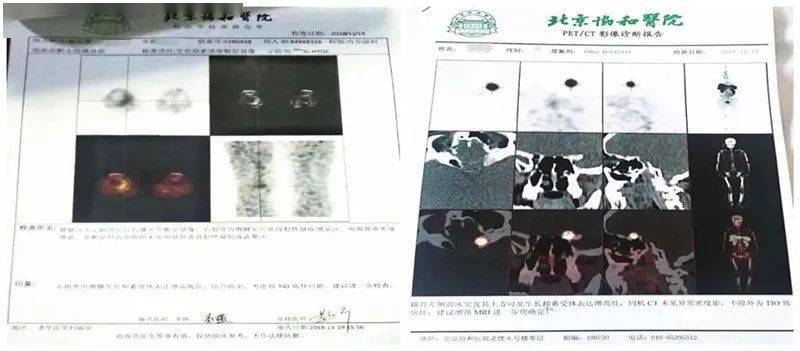 行走|【医文医话】罕见病例 | 低磷骨软化症确诊治疗始末