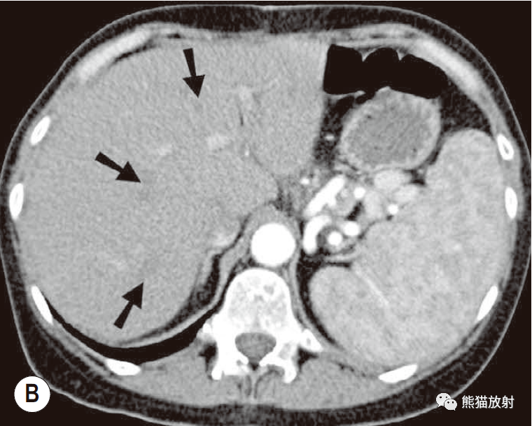 正常肝脏核磁共振图片图片
