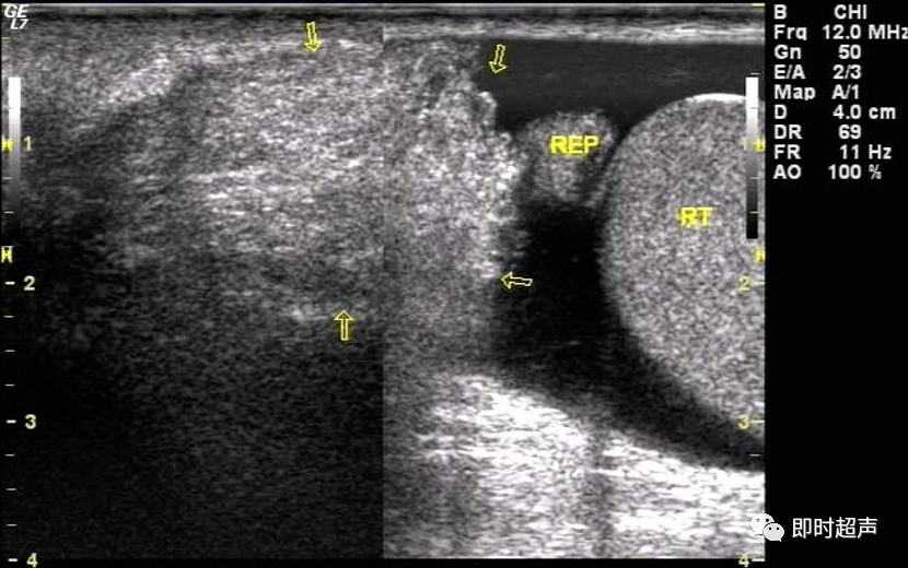 精彩睾丸鞘膜积液与腹股沟斜疝的超声诊断超人必看