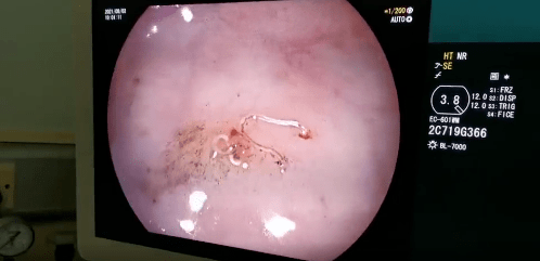 小青|头皮发麻！爱吃这种美食，女孩肠道内竟布满密密麻麻的…