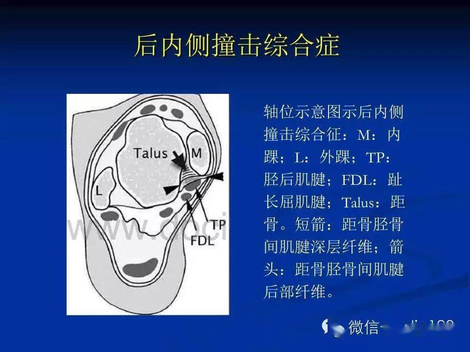 前外側撞擊綜合症:踝關節旋後損傷通常導致距腓前韌帶,跟腓韌帶以及前