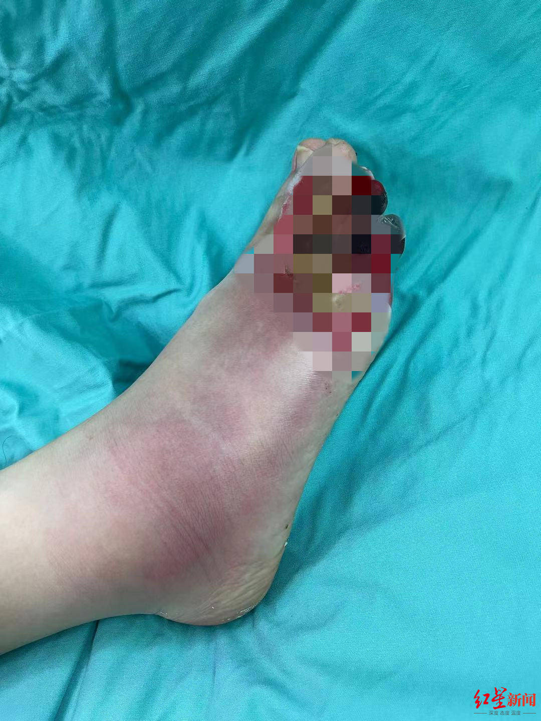 伤情|烫伤变冻伤！17岁男生用“迅速降温剂”降温，险被截趾