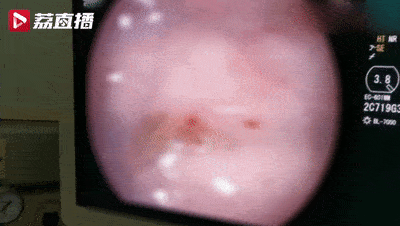 17岁少女肠道内布满寄生虫 还活蹦乱跳的 医生都吓一跳 小青