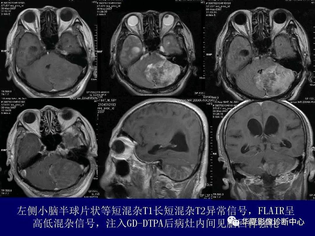 诊断|缺血性脑血管病的影像诊断