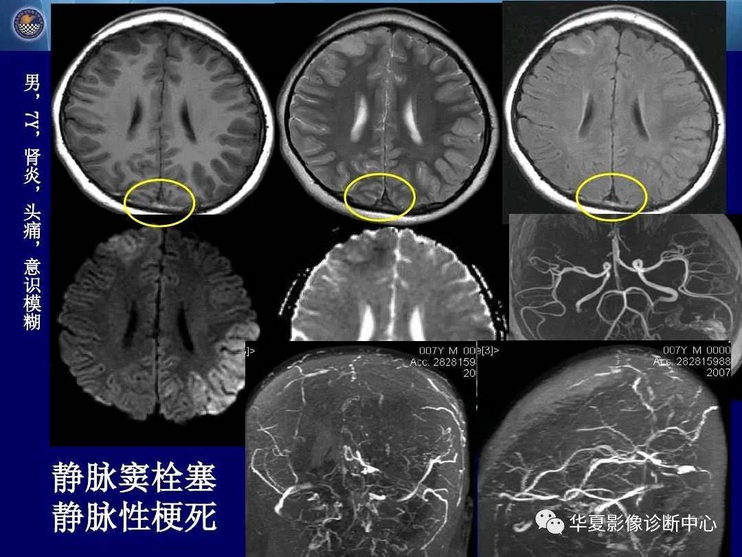 诊断|缺血性脑血管病的影像诊断