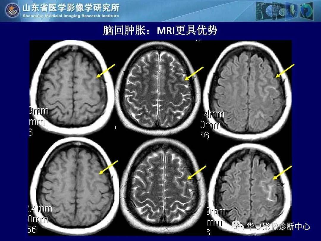 诊断|缺血性脑血管病的影像诊断