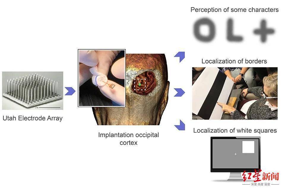 电极|让盲人不用眼睛也能重见光明，这套高科技设备做到了!