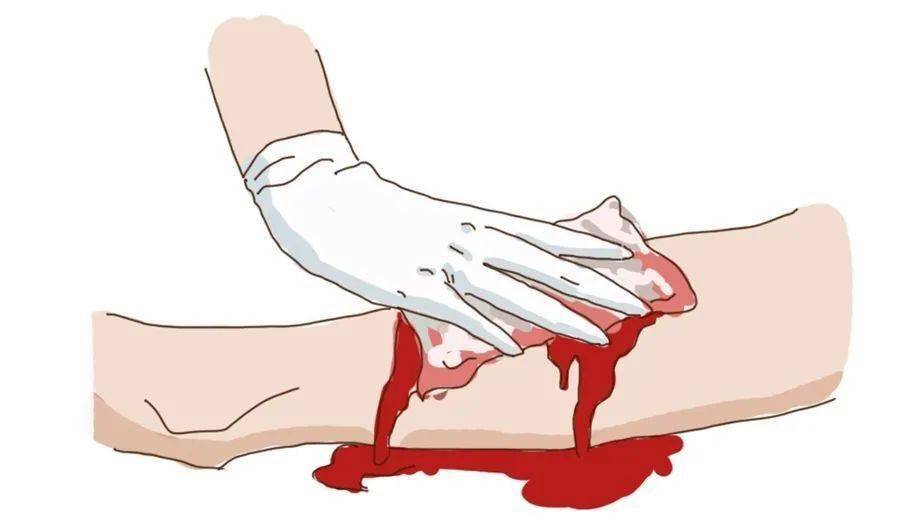 抠了一下杭州大伯蚯蚓腿喷血到休克这种青筋严重起来要人命