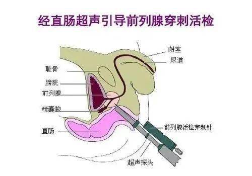 病理科|蒲江县人民医院成功开展经直肠超声引导下前列腺穿刺活检术