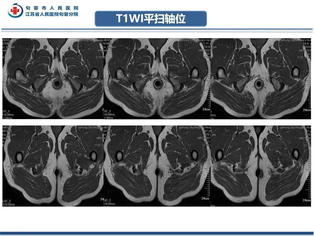 肛提肌mri图片