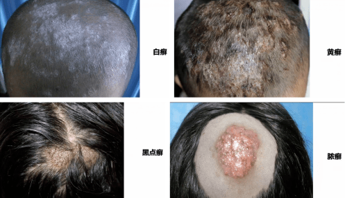 白癣黑点癣黄癣脓癣有何区别如何诊治