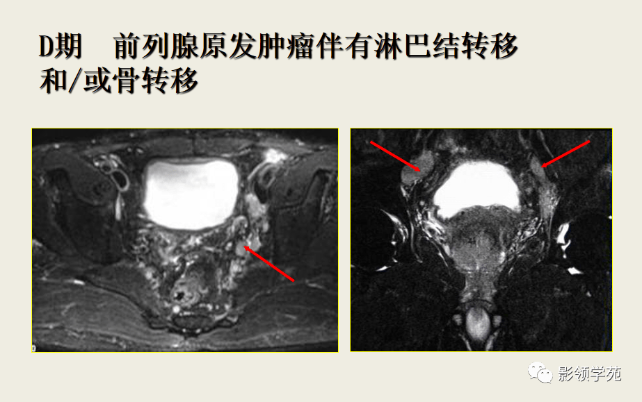 CRPC前列腺癌图片