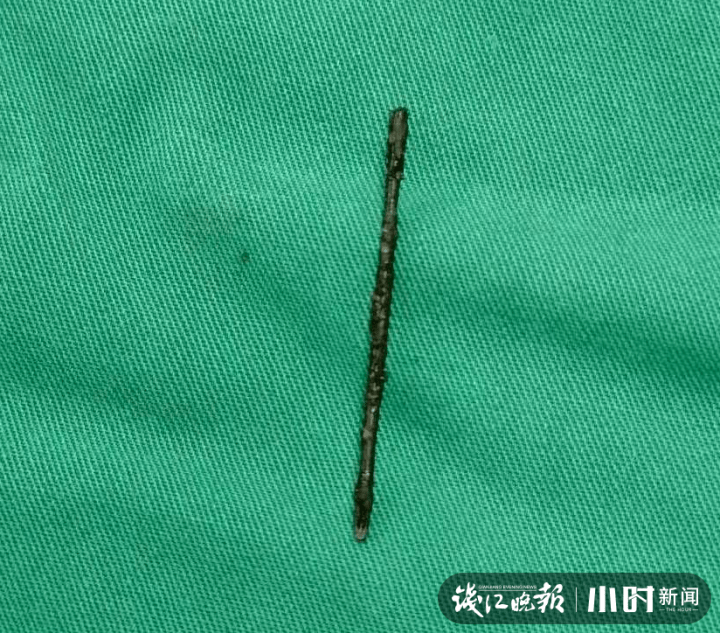 绣花针|一根“绣花针”竟在身体里藏了二十多年，医生：运气太好了