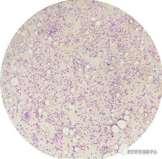 骨髓塗片b超檢查淋巴細胞甲功 腫瘤標誌物免疫球蛋白 補體凝血檢查