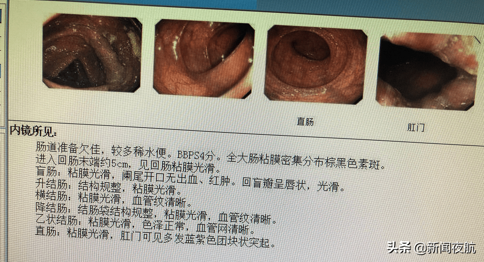 男子|悔不当初，男子肠子粗得碗口大，全因常吃乱吃这东西