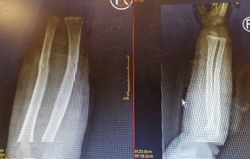 手术|4龄童滑滑梯时意外骨折，纯手法复位20秒快速搞定