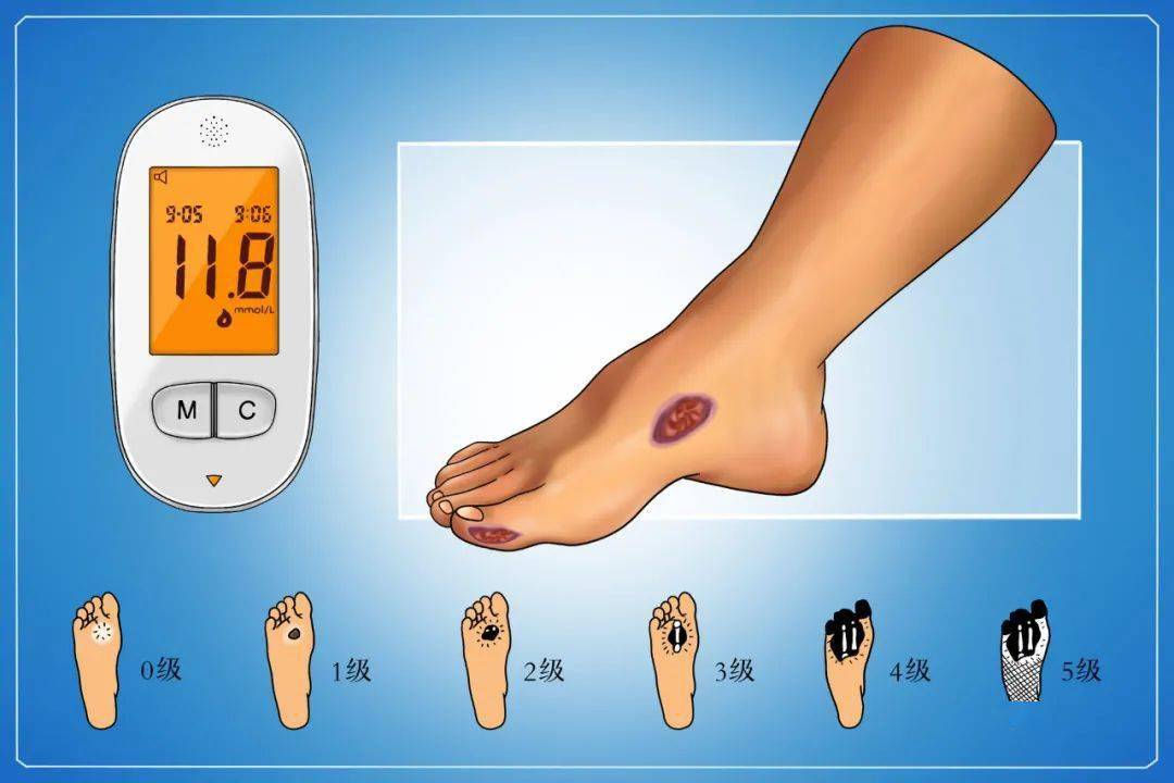治疗|【眉县疾控提醒您】联合国糖尿病日丨人人享有糖尿病健康管理