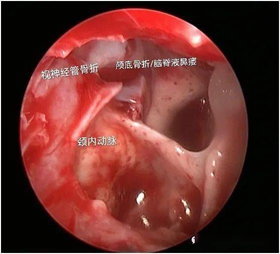 麻醉手术科 神经外科助力 3位鼻科医生 挽救14岁男孩视力 视神经