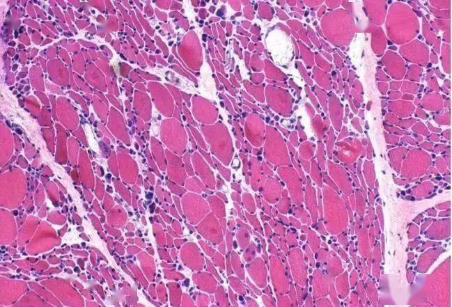 科普|?【积医科普】出现这些症状,当心肌肉疾病