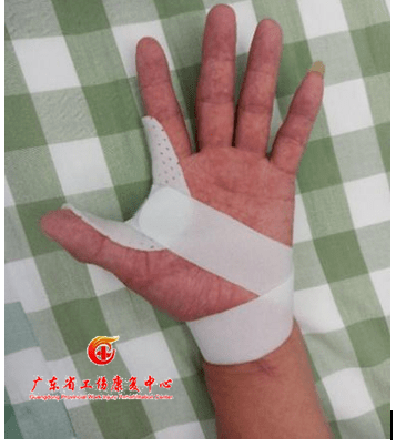 手功能基地系列微文14手部虎口挛缩后功能重建