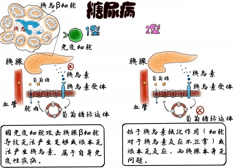 症状|联合国糖尿病日｜教您如何区别1型糖尿病和2型糖尿病