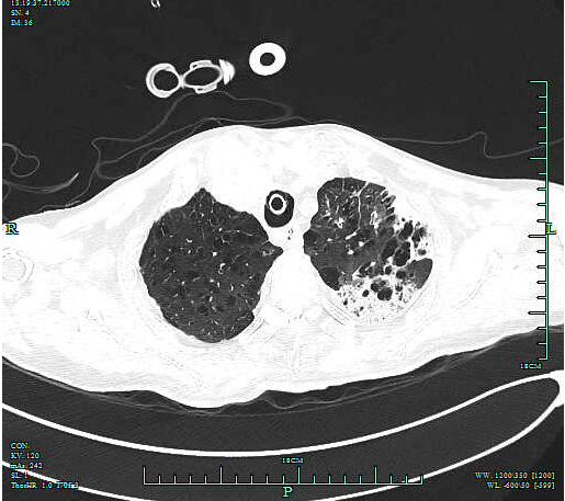 检查|【新闻快递】呼吸重症监护室成功开展两例危重症患者“床旁超声引导下经皮肺穿刺组织活检术”