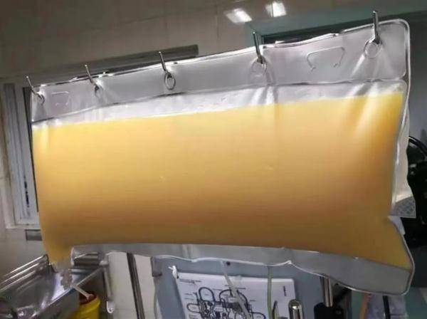 血脂|血液中透析出2升油浆！这个习惯很多人都有