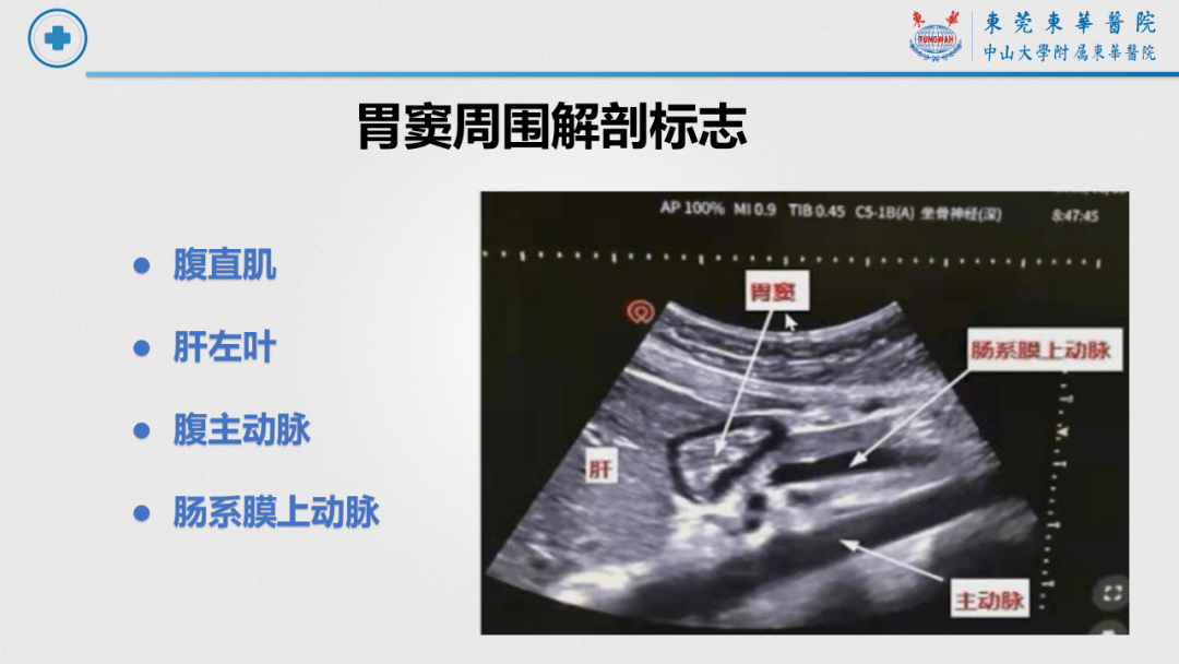 正常胃的超声图像图片