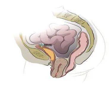 盆腔分为前,中,后盆腔,前盆腔内器官有尿道,膀胱,阴道前壁,中盆腔有内