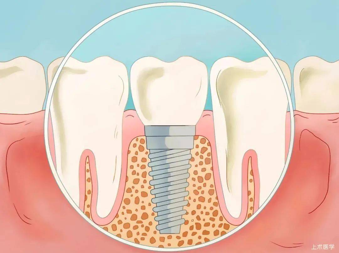 最全的口腔种植牙介绍,值得收藏!