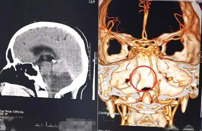 检查|31岁男子长期做这事，竟突发小脑梗死！这习惯很多人都有