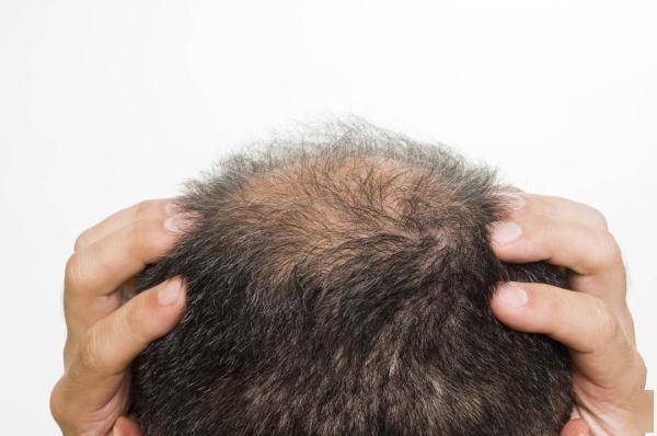 治疗|我国2.5亿人受脱发困扰，头发“求救信号”你收到了吗