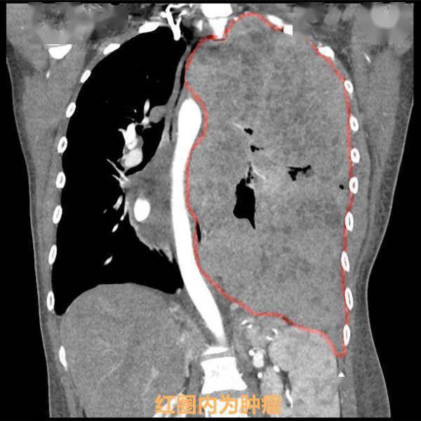 肿瘤|惊了！这个“小毛病”，竟把女子左肺“压没了”？